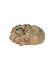 Sezione sagittale della testa con dissezione della fossa infratemporale E Sezione sagittale della testa con dissezione della fossa infratemporale E