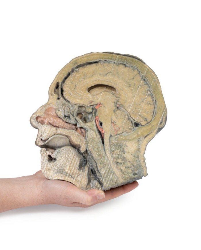 Sezione sagittale della testa con dissezione della fossa infratemporale E Sezione sagittale della testa con dissezione della fossa infratemporale E