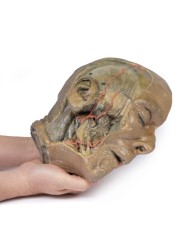 Sezione sagittale della testa con dissezione della fossa infratemporale E Sezione sagittale della testa con dissezione della fossa infratemporale E