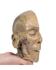 Sezione sagittale della testa con dissezione della fossa infratemporale E Sezione sagittale della testa con dissezione della fossa infratemporale E