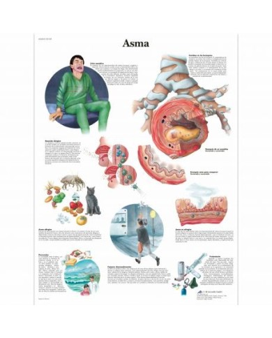 3B Scientific, tavola anatomica, Asma (cod, VR4328UU) 3B Scientific, tavola anatomica, Asma (cod, VR4328UU)