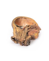 Sezione sagittale di testa e collo con fossa intratemporale e guaina caroti