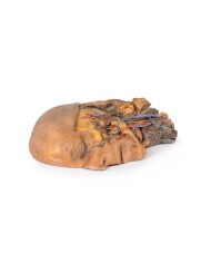 Sezione sagittale di testa e collo con fossa intratemporale e guaina caroti