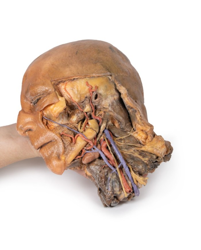 Sezione sagittale di testa e collo con fossa intratemporale e guaina caroti