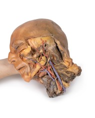 Sezione sagittale di testa e collo con fossa intratemporale e guaina caroti