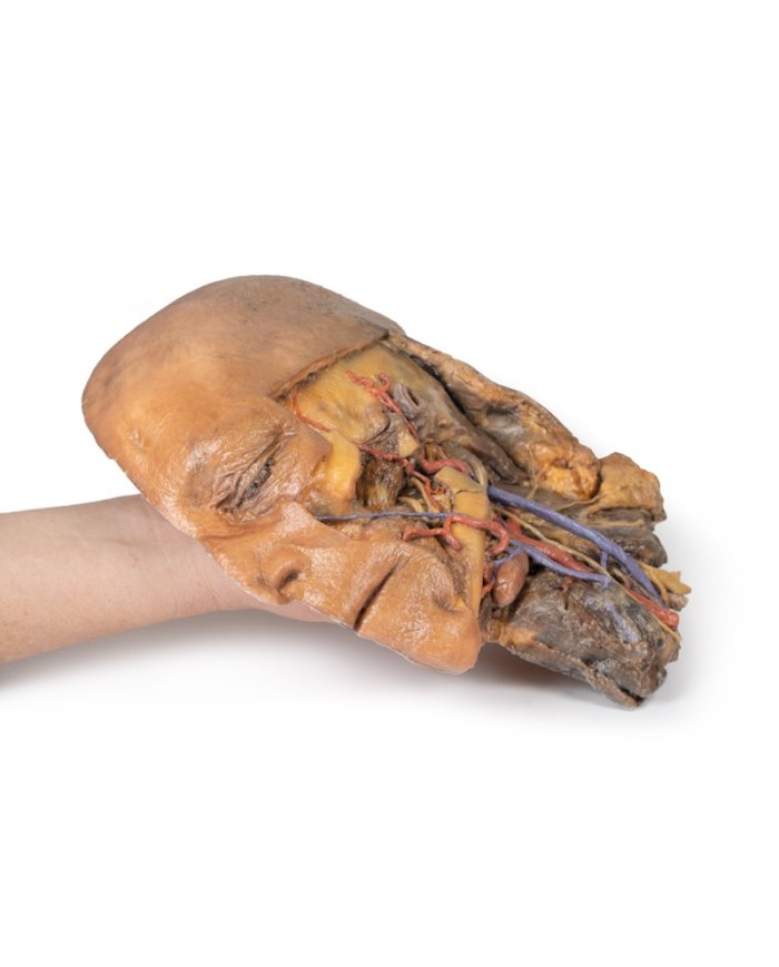 Sezione sagittale di testa e collo con fossa intratemporale e guaina caroti