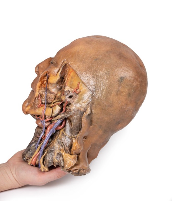 Sezione sagittale di testa e collo con fossa intratemporale e guaina caroti