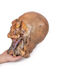 Sezione sagittale di testa e collo con fossa intratemporale e guaina caroti