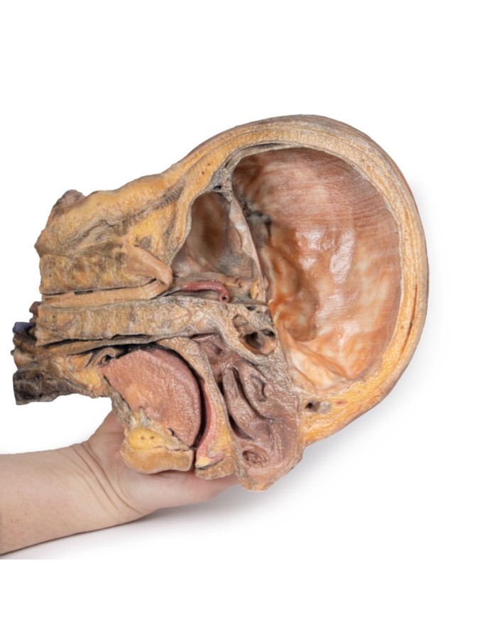 Sezione sagittale di testa e collo con fossa intratemporale e guaina caroti