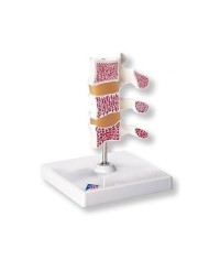 3B Scientific, modello anatomico di lusso, Osteoporosi,  A78