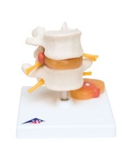 Modello di vertebre lombari con ernia al disco 3B Scientific A76