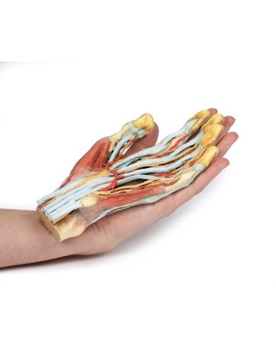 Modello anatomico di mano e polso con sindrome del tunnel carpale Modello anatomico di mano e polso con sindrome del tunnel carpale