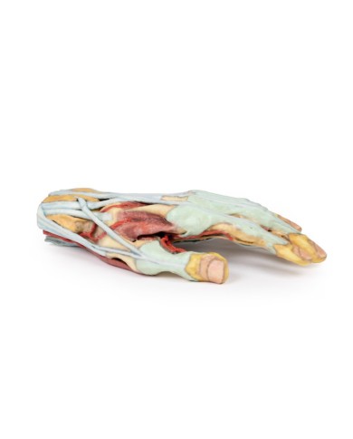 Modello anatomico di mano e polso con sindrome del tunnel carpale Modello anatomico di mano e polso con sindrome del tunnel carpale