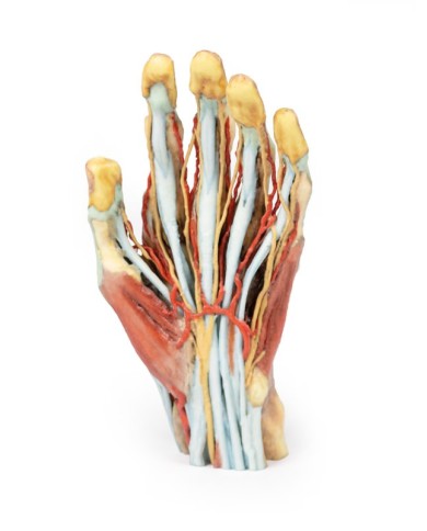 Modello anatomico di mano e polso con sindrome del tunnel carpale Modello anatomico di mano e polso con sindrome del tunnel carpale