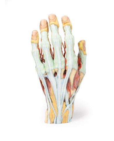 Modello anatomico di mano e polso con sindrome del tunnel carpale Modello anatomico di mano e polso con sindrome del tunnel carpale