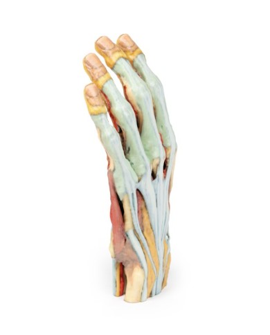 Modello anatomico di mano e polso con sindrome del tunnel carpale Modello anatomico di mano e polso con sindrome del tunnel carpale