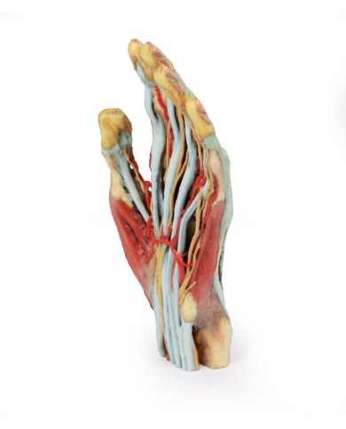 Modello anatomico di mano e polso con sindrome del tunnel carpale Modello anatomico di mano e polso con sindrome del tunnel carpale