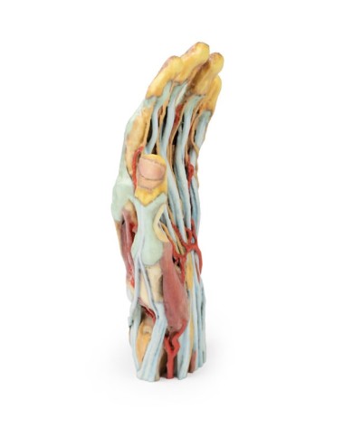 Modello anatomico di mano e polso con sindrome del tunnel carpale Modello anatomico di mano e polso con sindrome del tunnel carpale