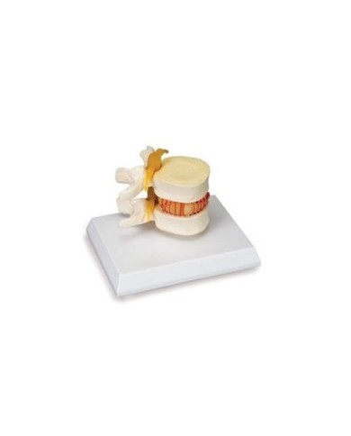 3B Scientific, modello di simulatore di disco erniato  W22230