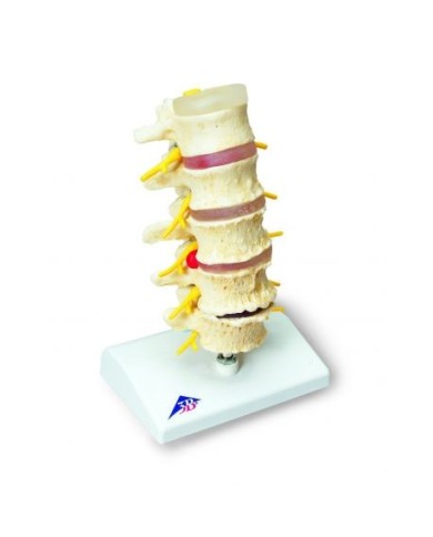 3B Scientific, Stadi dell'ernia del disco intervertebrale e degenerazione della vertebra A795