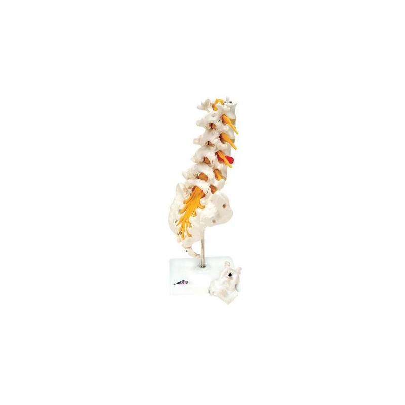 Colonna vertebrale lombare 3B Scientific con ernia del disco dorsolaterale  A76/5