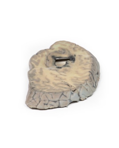 Emorragia cerebrale Erler Zimmer 3D anatomy Series MP2002