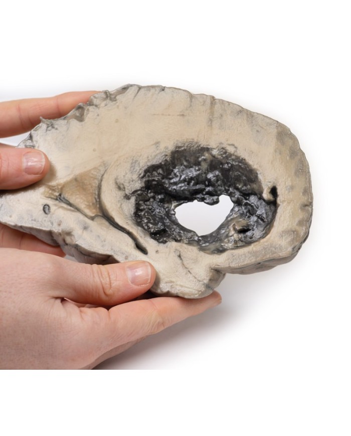 Emorragia cerebrale Erler Zimmer 3D anatomy Series MP2002