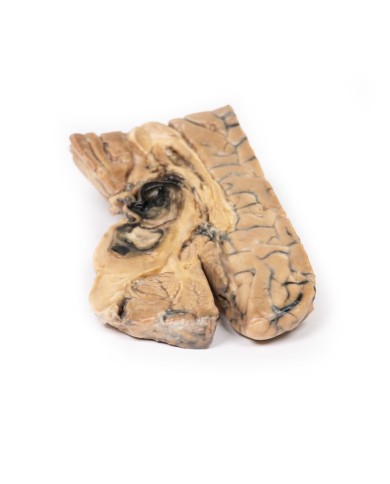 Aneurisma di Berry dell arteria basilare Erler Zimmer 3D anatomy Series M