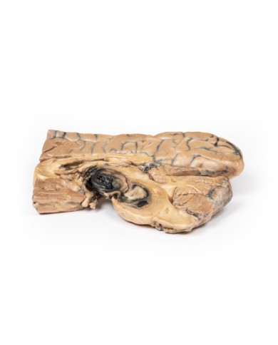 Aneurisma di Berry dell arteria basilare Erler Zimmer 3D anatomy Series M