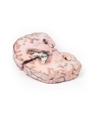 Glioma di grado 3 4 che ha causato papilledema Erler Zimmer 3D anatomy S Glioma di grado 3 4 che ha causato papilledema Erler Zimmer 3D anatomy S