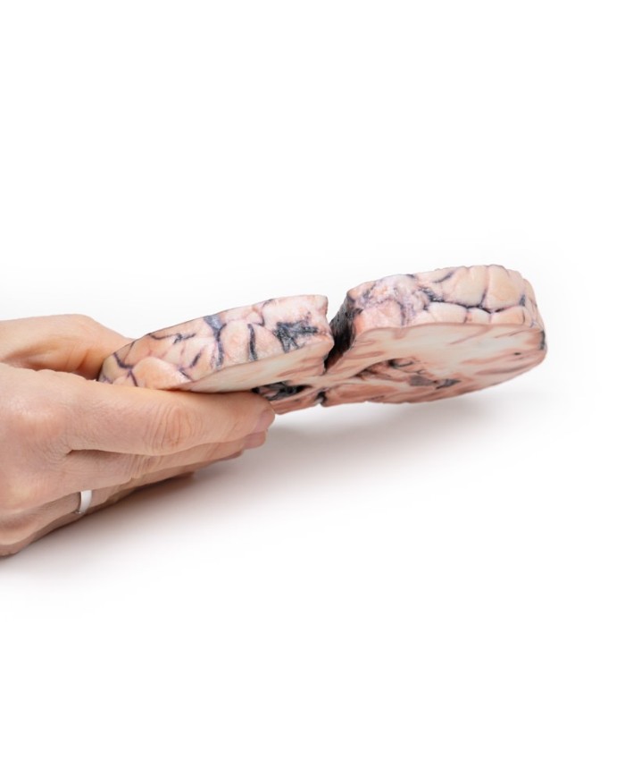 Glioma di grado 3 4 che ha causato papilledema Erler Zimmer 3D anatomy S Glioma di grado 3 4 che ha causato papilledema Erler Zimmer 3D anatomy S