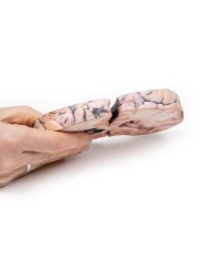 Glioma di grado 3 4 che ha causato papilledema Erler Zimmer 3D anatomy S Glioma di grado 3 4 che ha causato papilledema Erler Zimmer 3D anatomy S