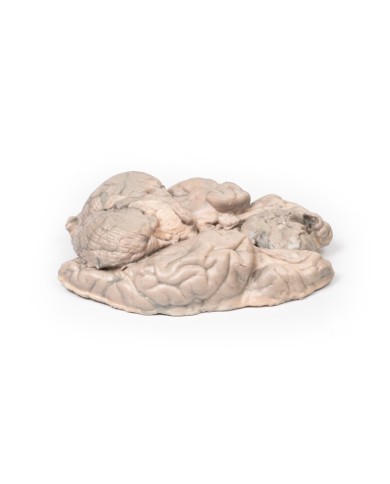 Meningioma Erler Zimmer 3D anatomy Series MP2004