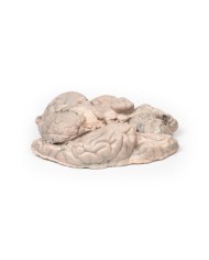 Meningioma Erler Zimmer 3D anatomy Series MP2004 Meningioma Erler Zimmer 3D anatomy Series MP2004