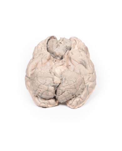 Meningioma Erler Zimmer 3D anatomy Series MP2004