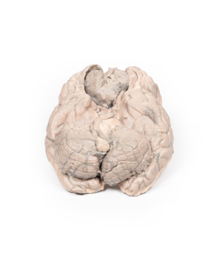 Meningioma Erler Zimmer 3D anatomy Series MP2004 Meningioma Erler Zimmer 3D anatomy Series MP2004