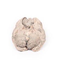 Meningioma Erler Zimmer 3D anatomy Series MP2004 Meningioma Erler Zimmer 3D anatomy Series MP2004