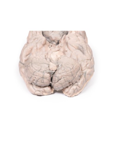 Meningioma Erler Zimmer 3D anatomy Series MP2004