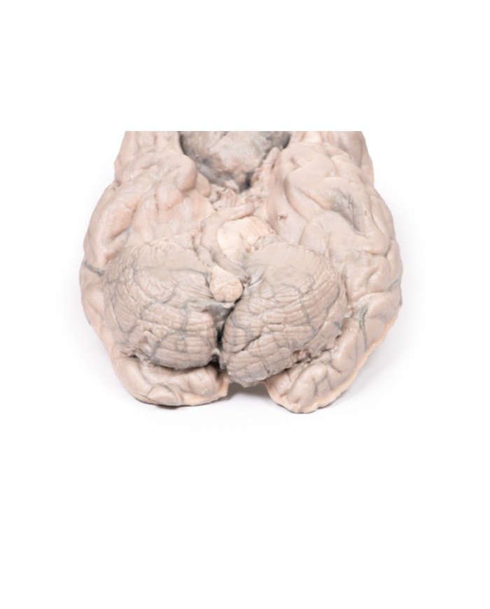 Meningioma Erler Zimmer 3D anatomy Series MP2004 Meningioma Erler Zimmer 3D anatomy Series MP2004