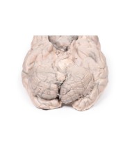 Meningioma Erler Zimmer 3D anatomy Series MP2004 Meningioma Erler Zimmer 3D anatomy Series MP2004