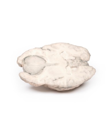 Meningioma Erler Zimmer 3D anatomy Series MP2004