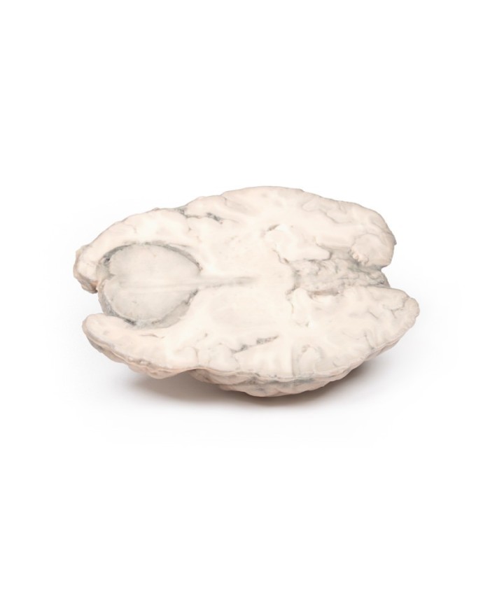 Meningioma Erler Zimmer 3D anatomy Series MP2004 Meningioma Erler Zimmer 3D anatomy Series MP2004