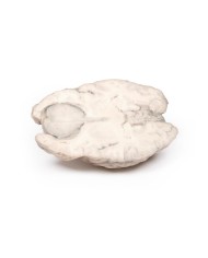 Meningioma Erler Zimmer 3D anatomy Series MP2004 Meningioma Erler Zimmer 3D anatomy Series MP2004