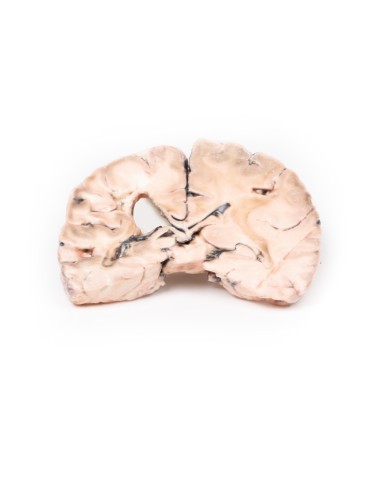 Infarto cerebrale sinistro Erler Zimmer 3D anatomy Series MP2005