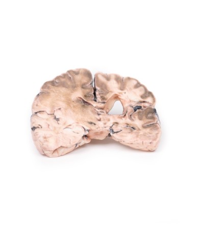 Infarto cerebrale sinistro Erler Zimmer 3D anatomy Series MP2005