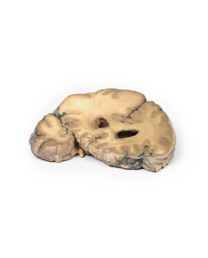 Adenocarcinoma metastatico nel cervello Erler Zimmer 3D anatomy Series MP Adenocarcinoma metastatico nel cervello Erler Zimmer 3D anatomy Series MP