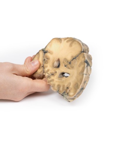 Adenocarcinoma metastatico nel cervello Erler Zimmer 3D anatomy Series MP