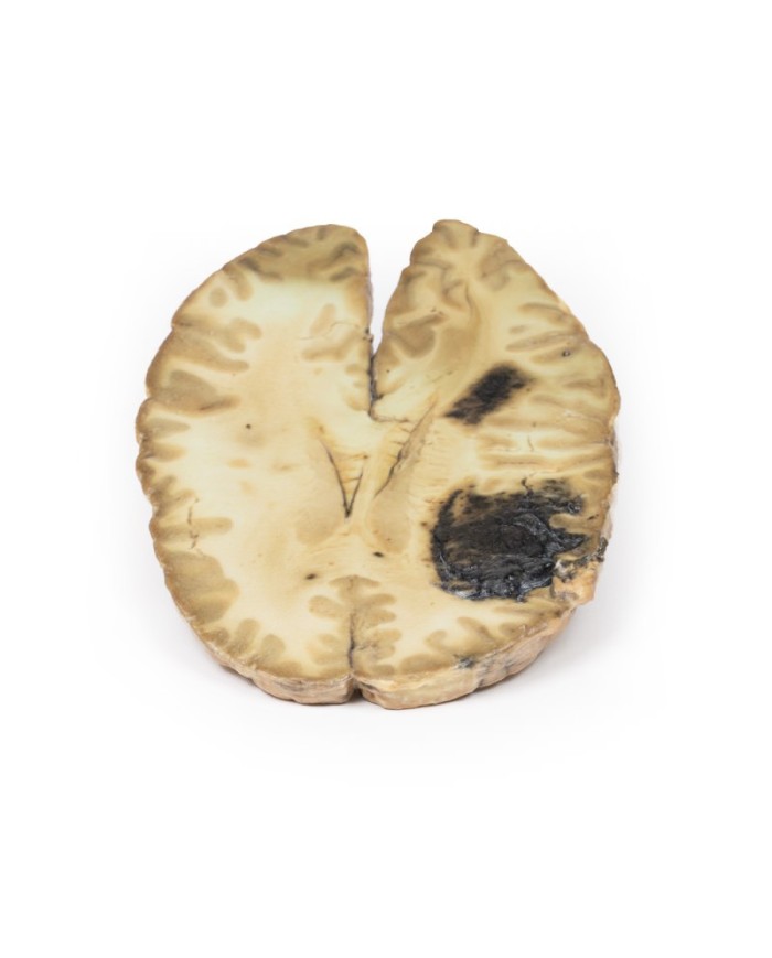 Emorragia cerebrale secondaria a leucemia mieloide acuta Erler Zimmer 3D Emorragia cerebrale secondaria a leucemia mieloide acuta Erler Zimmer 3D