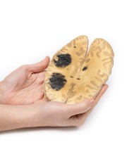 Emorragia cerebrale secondaria a leucemia mieloide acuta Erler Zimmer 3D Emorragia cerebrale secondaria a leucemia mieloide acuta Erler Zimmer 3D