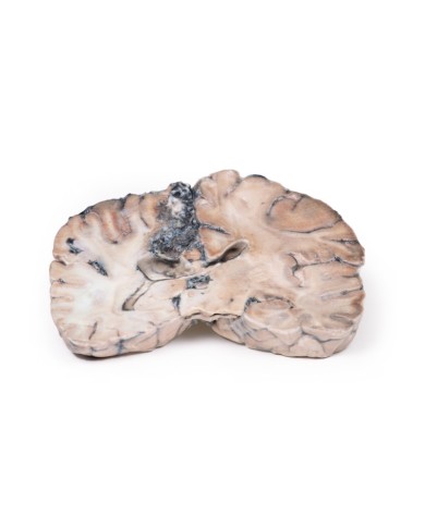 Malformazione Arterio Venosa Cerebrale Erler Zimmer 3D anatomy Series MP2